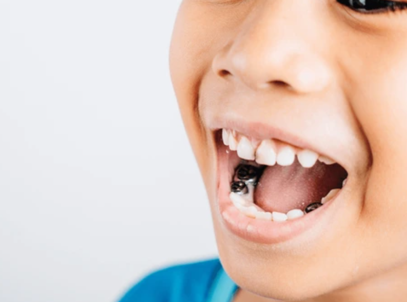 Prefabrik Zirkonyum Kuron