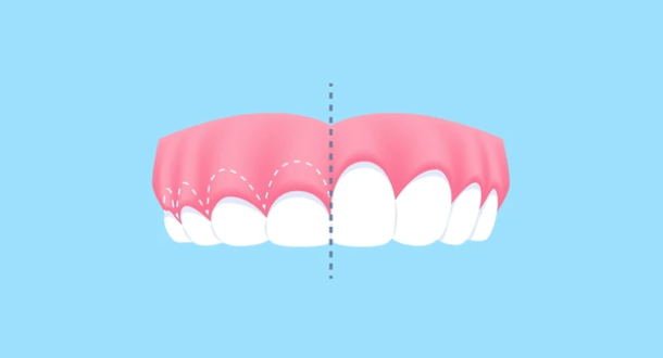 Gummy Smile (Diş Eti Estetiği)