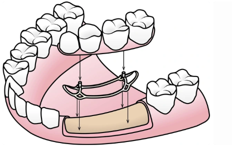 Subperiosteal İmplant