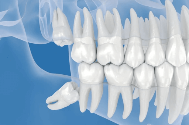 Gömülü Diş Çekimi Cerrahisi