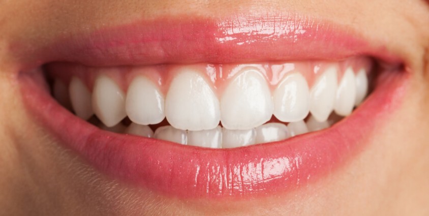 DSD Digital Smile Design (Estetik Gülüş Tasarımı)