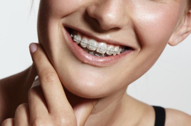 Estetik Seramik Braketler