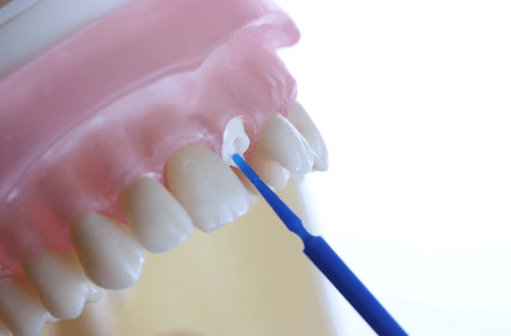 Fiber Post Kuron Uygulamaları