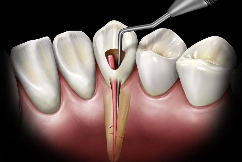 Kanal Tedavisi - Ataşehir