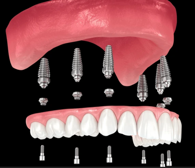 İmplant Üstü Protezler