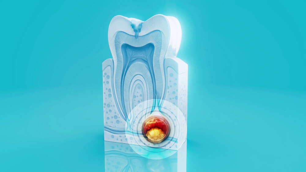 Retreatment (Kanal Tedavisi Tekrarı)