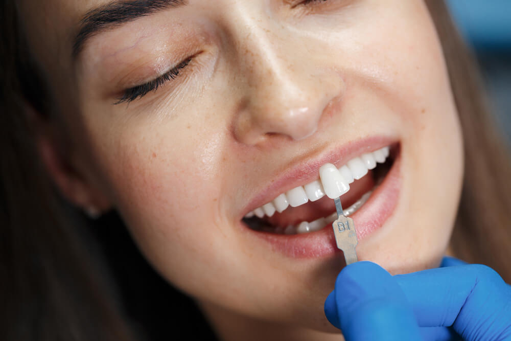 Veneer Kuron Kaplamalar