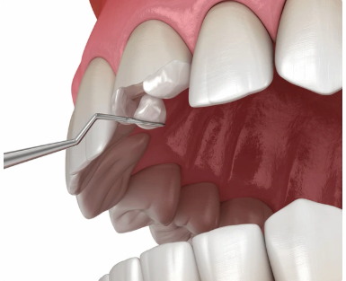 Estetik Kompozit Restorasyonlar